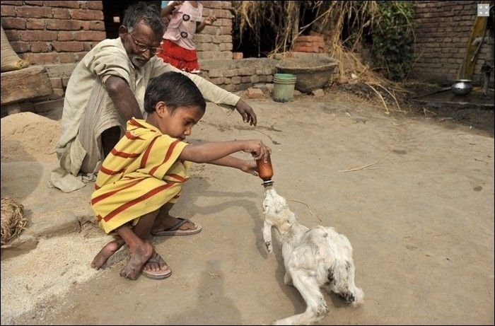 Deepak Kumar Paswaan, parasitic twin